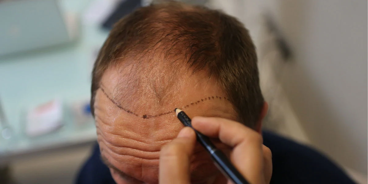 Illustration of hairline design during an assessment