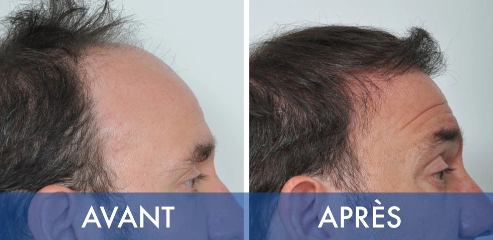 Before-and-after comparison — Hair transplant, example 4
