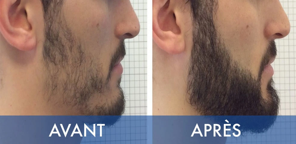 Before-and-after comparison — Beard transplant, example 5