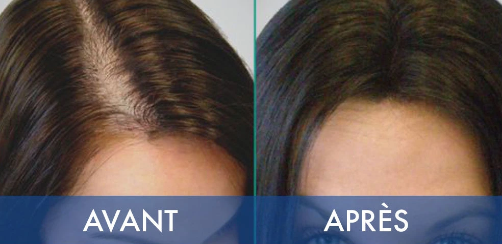 Before-and-after comparison — Hair transplant, example 3