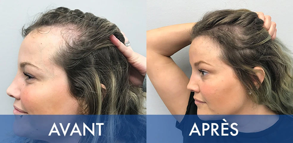 Before-and-after comparison — Hair transplant, example 2