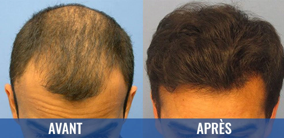 Comparaison avant et après — Greffe de cheveux, exemple 2