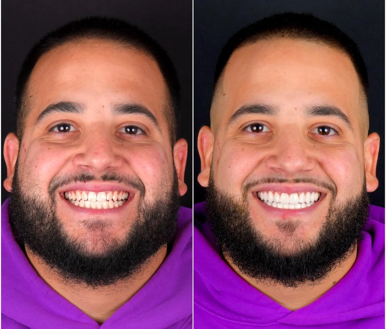 Before-and-after comparison — Teeth & smile, example 4