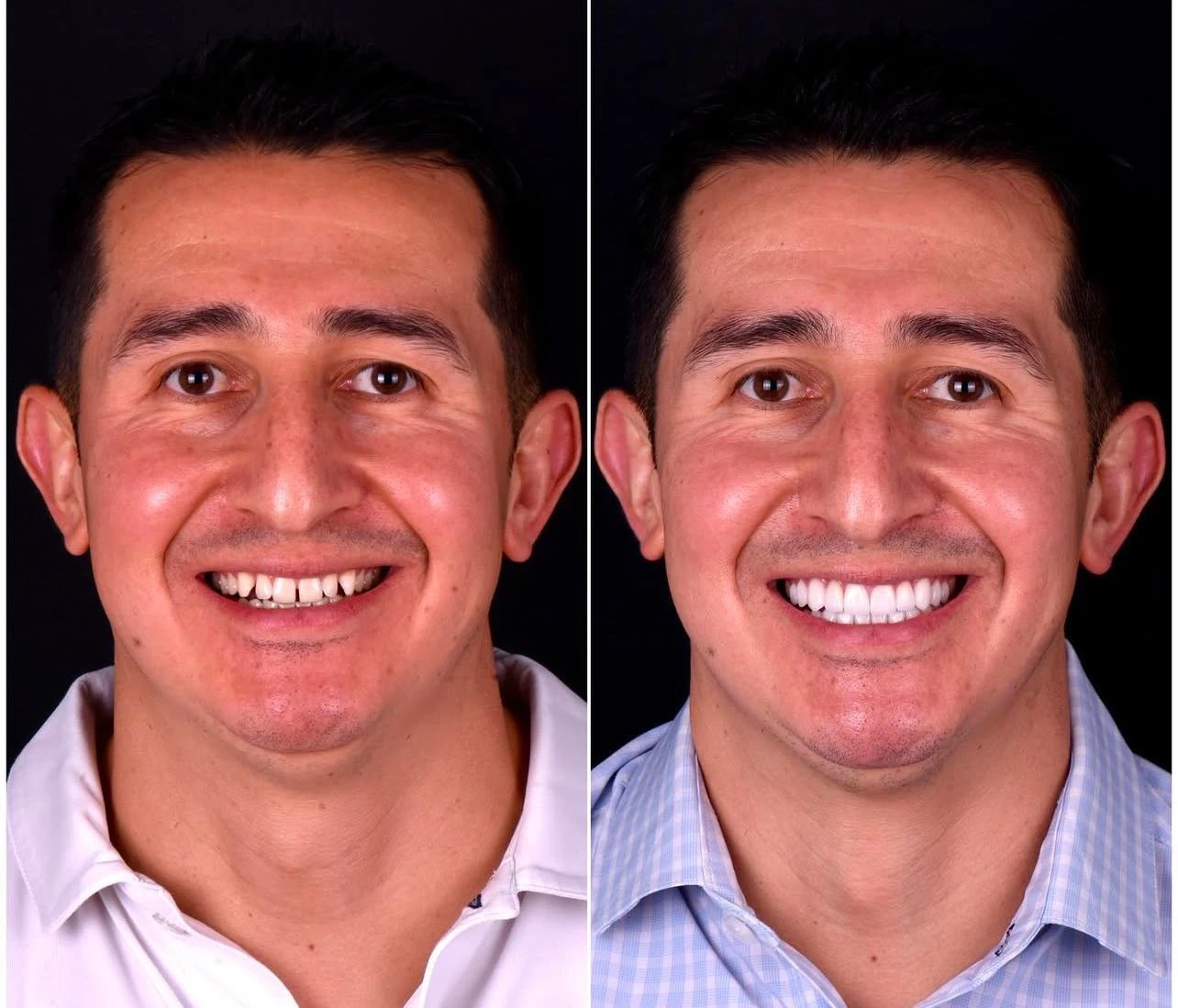 Before-and-after comparison — Teeth & smile, example 3