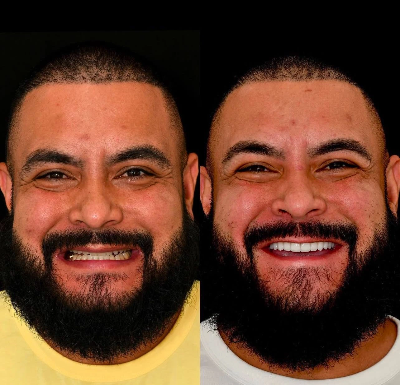 Before-and-after comparison — Teeth & smile, example 2