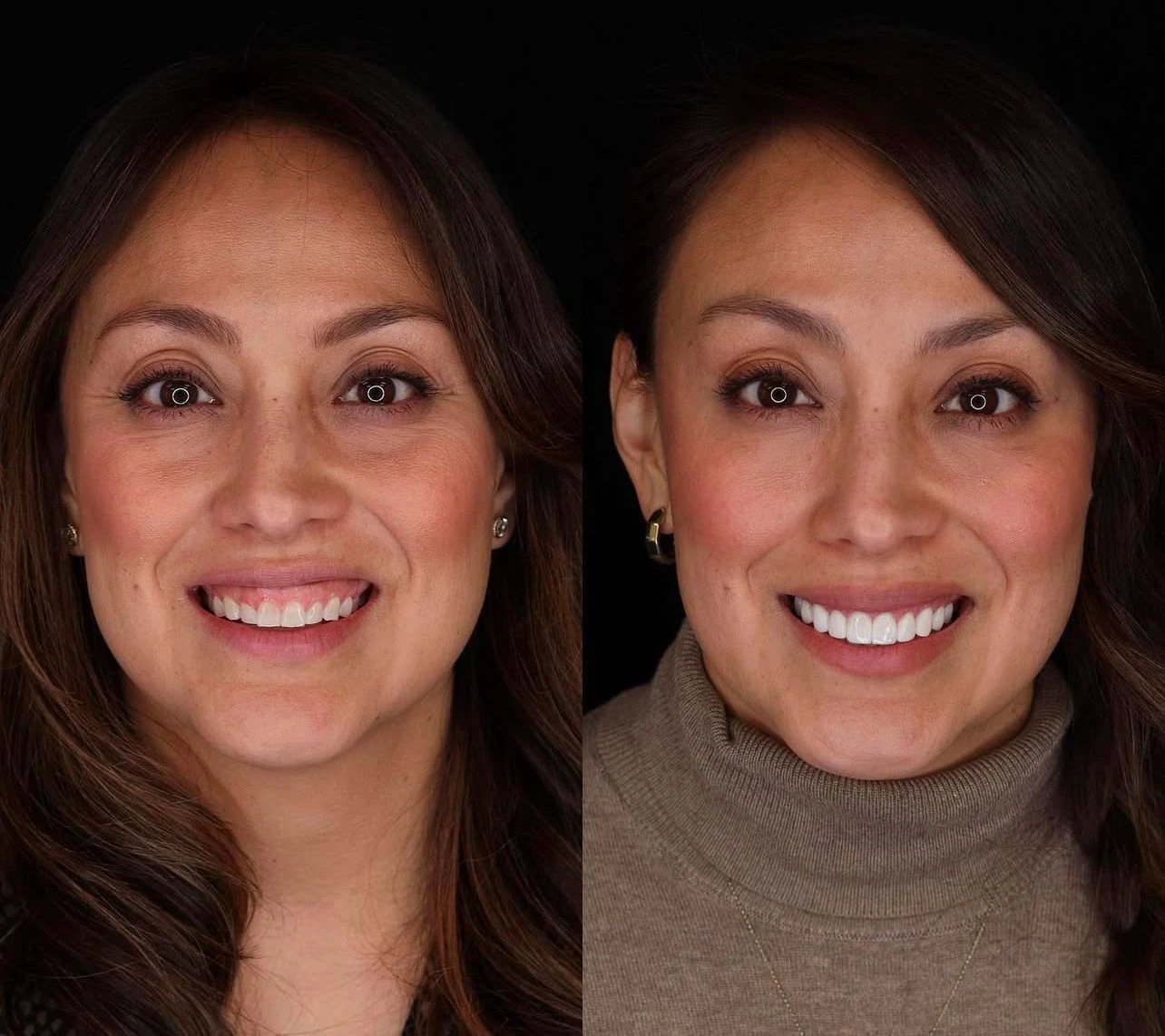 Comparaison avant et après — Dents & sourire, exemple 1