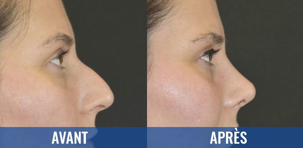 Comparaison avant et après — Rhinoplastie, exemple 3