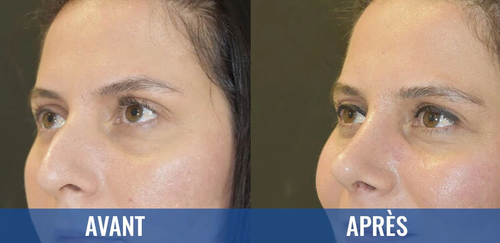Before-and-after comparison — Rhinoplasty, example 11