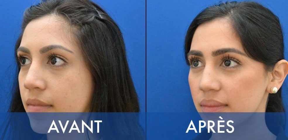 Before-and-after comparison — Buccal fat removal, example 12