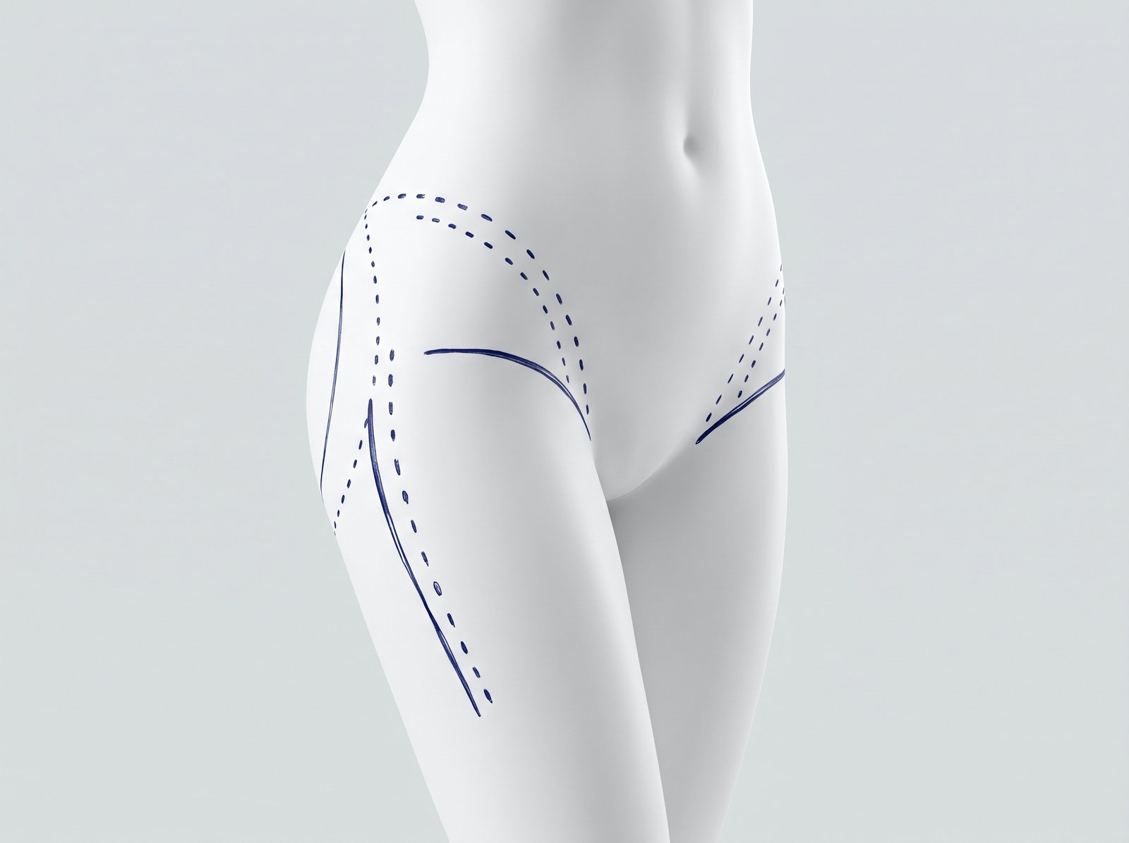 Conceptual illustration — thigh lift